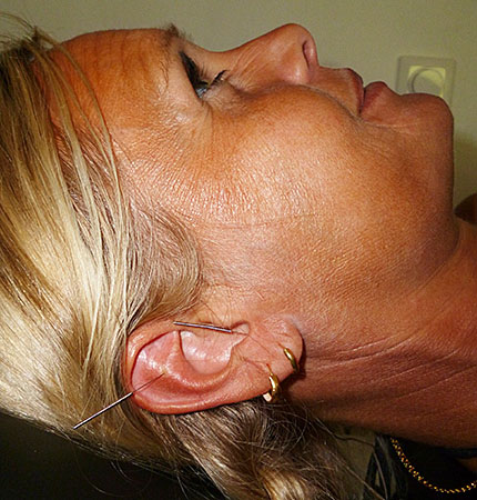 En patient med en nål på öronmussla